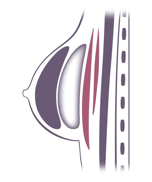 implante-mamario-subglandular