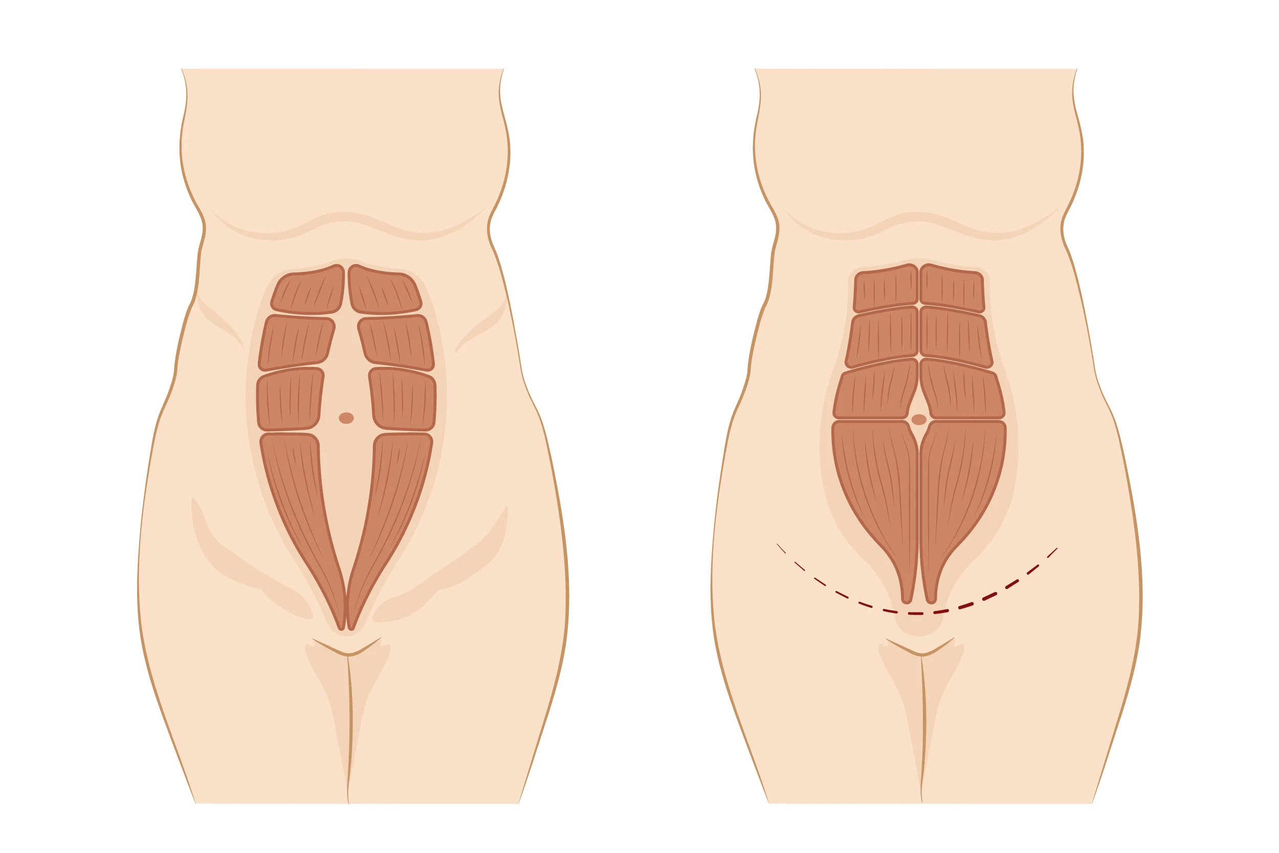 Abdominoplastia