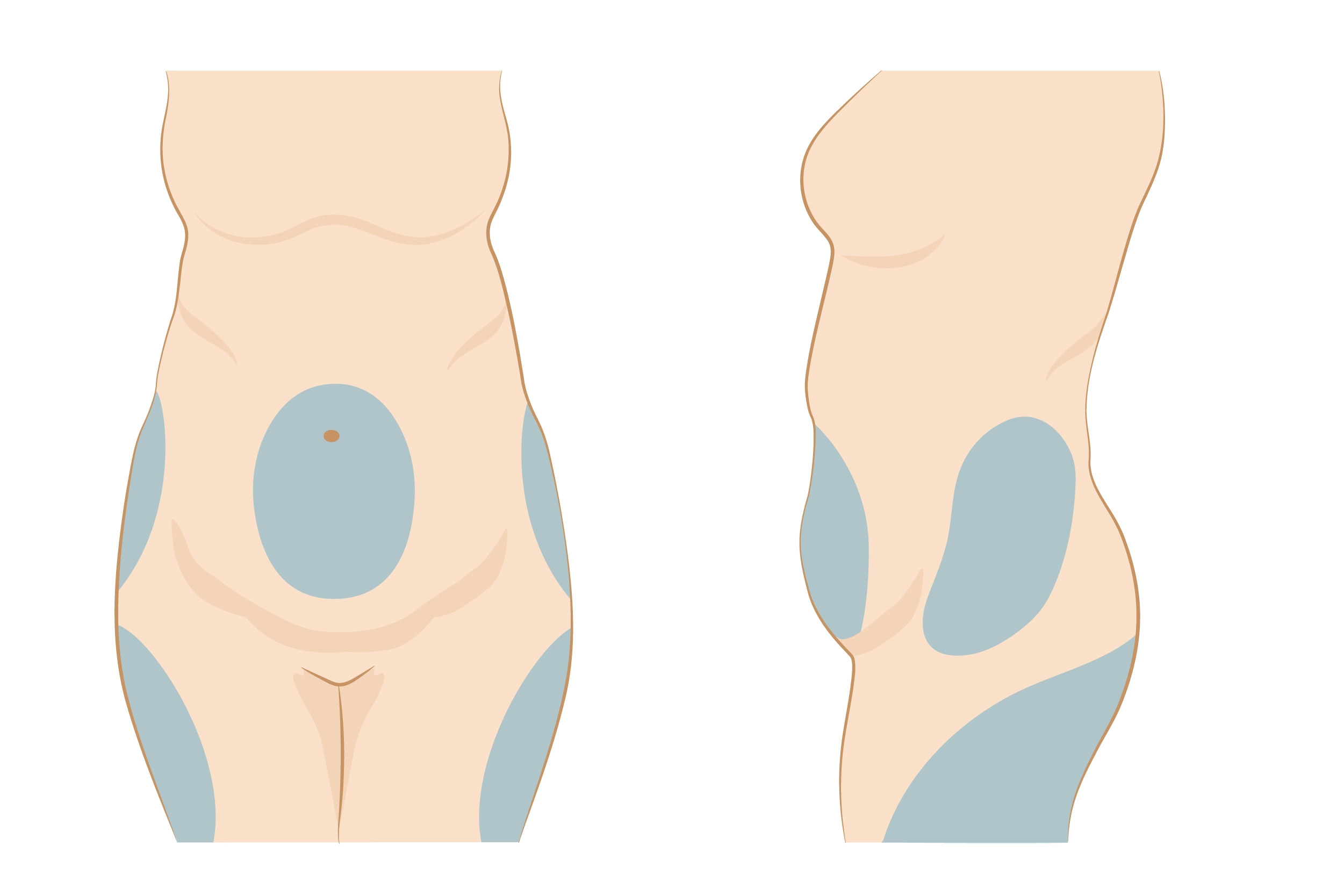 Lipoplastia