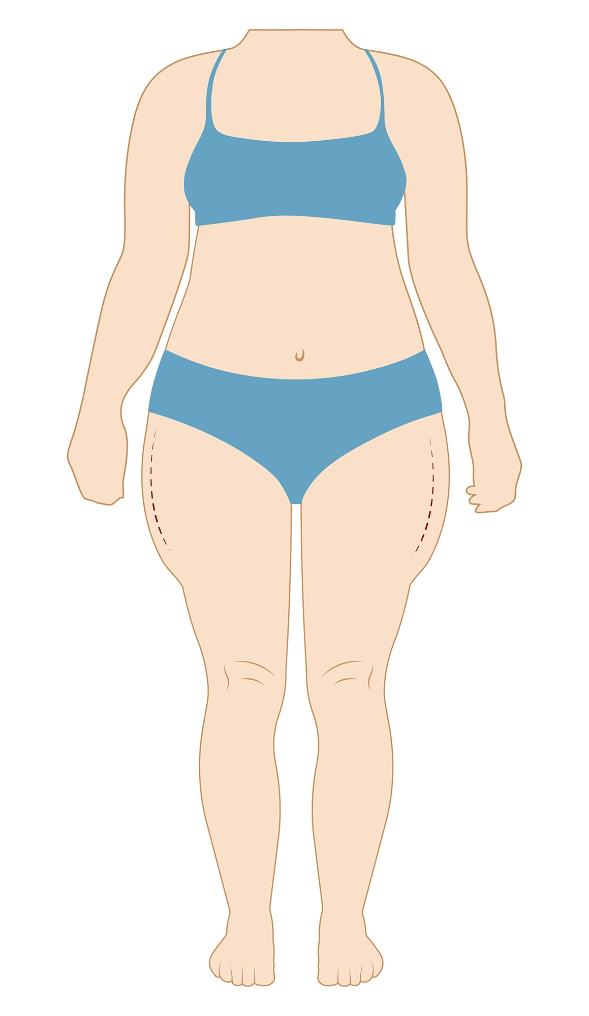 Tipos lipedema