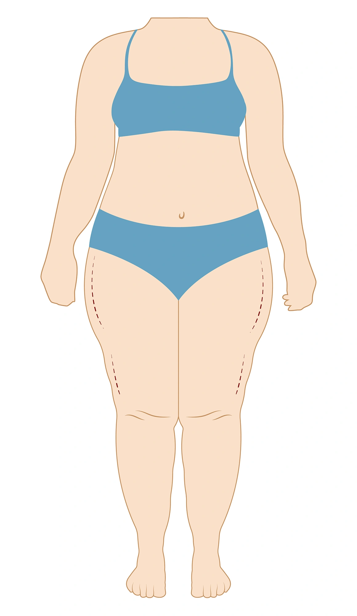 Tipos lipedema