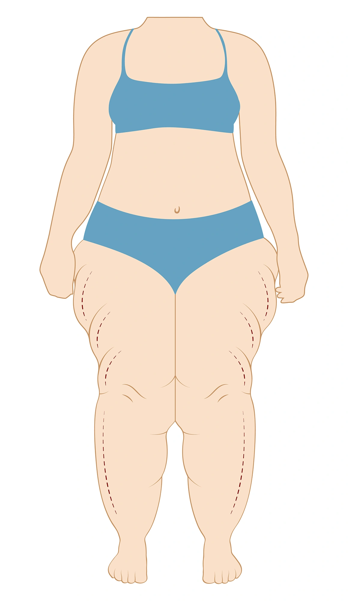 Tipos lipedema