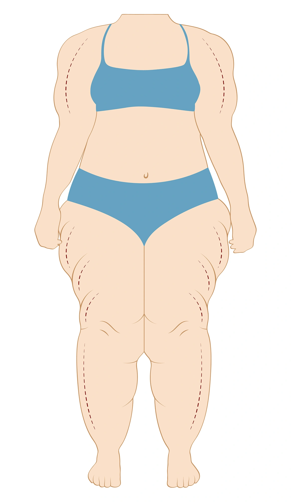 Tipos lipedema