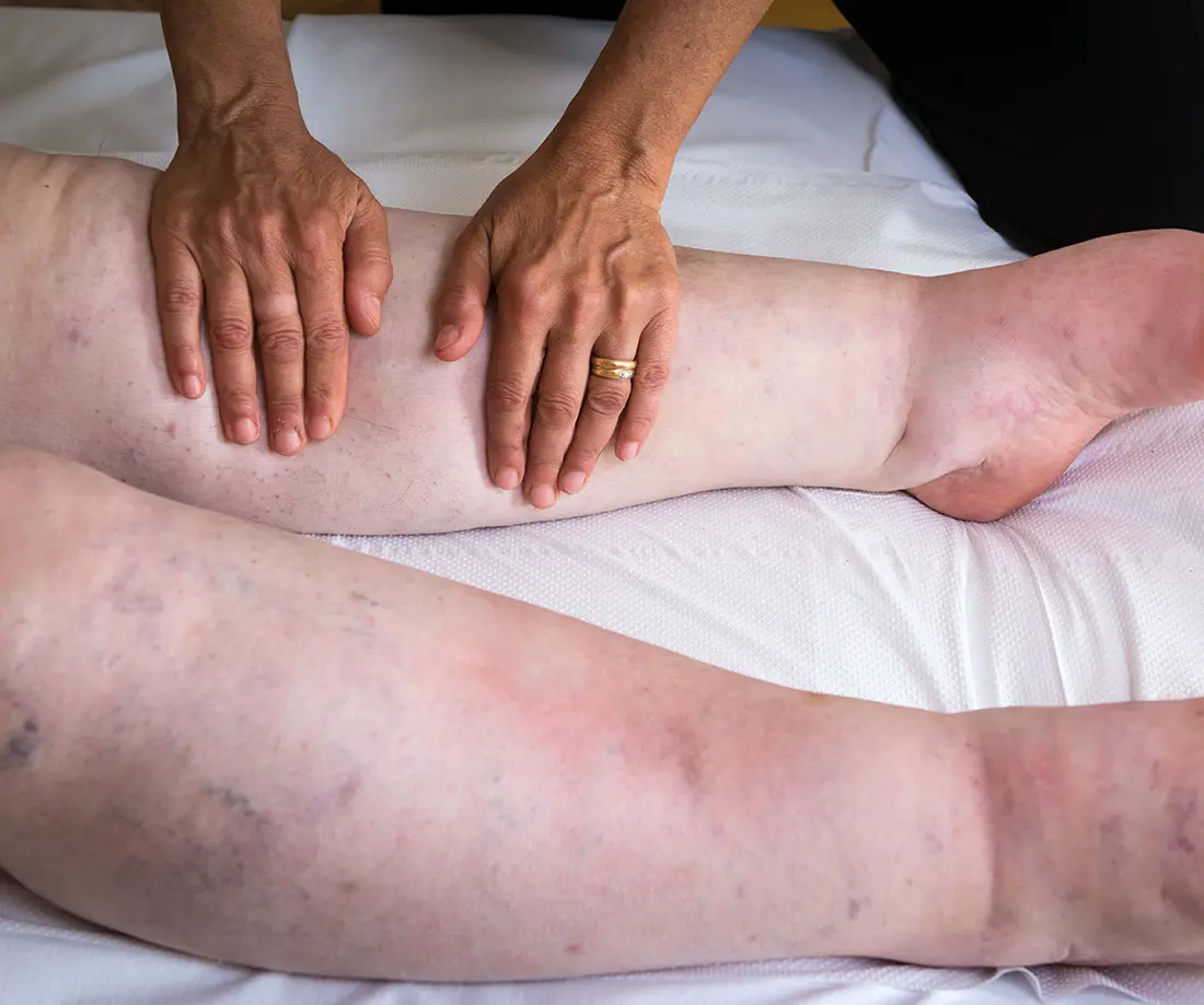 Soluciones para el lipedema