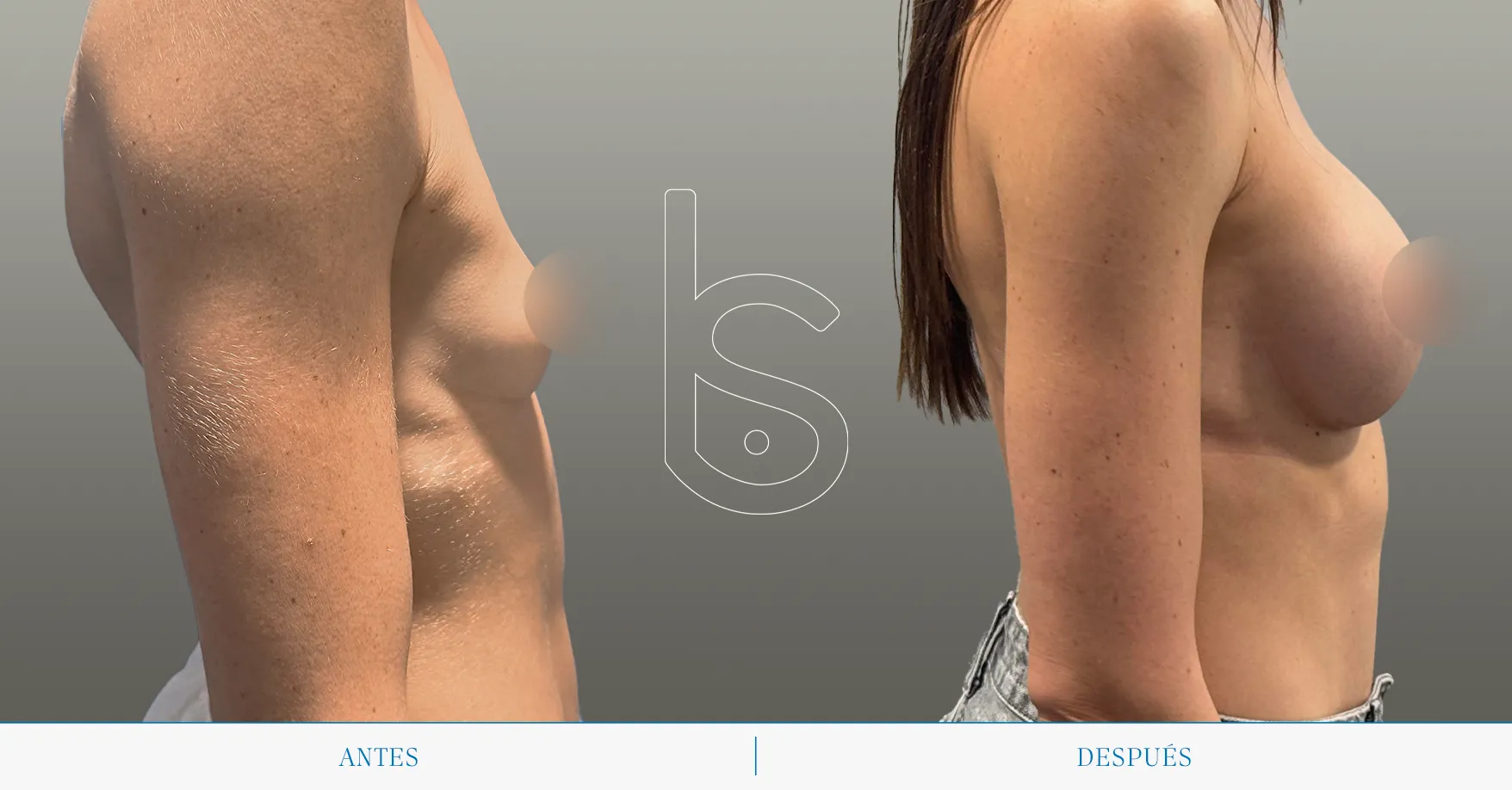 Caso de aumento perfil