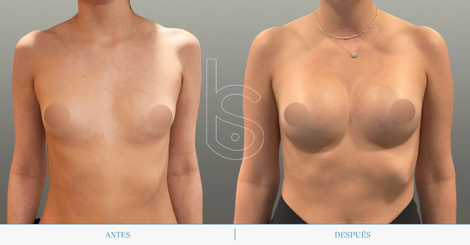 Caso de mamas tuberosas frente