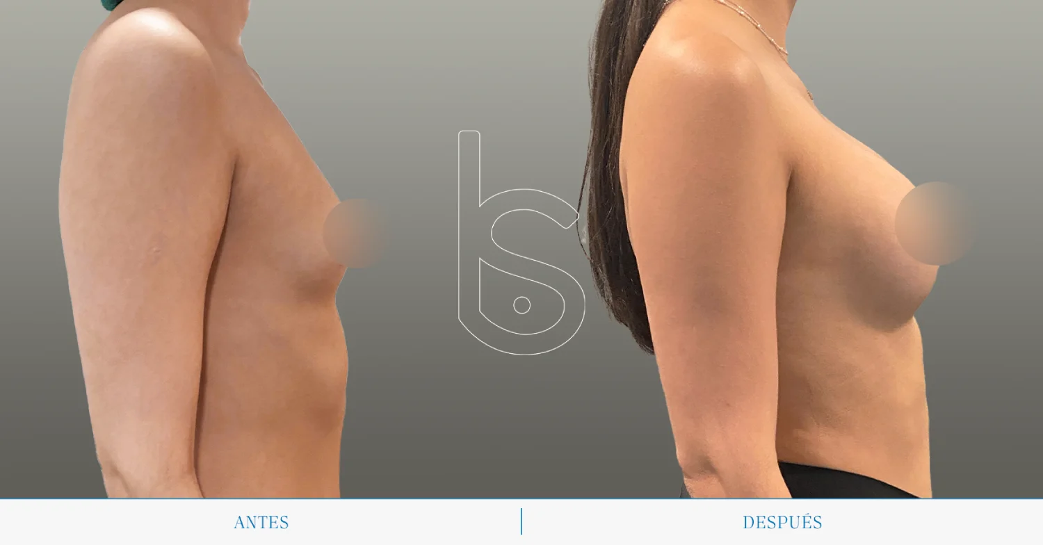 Caso de mamas tuberosas perfil