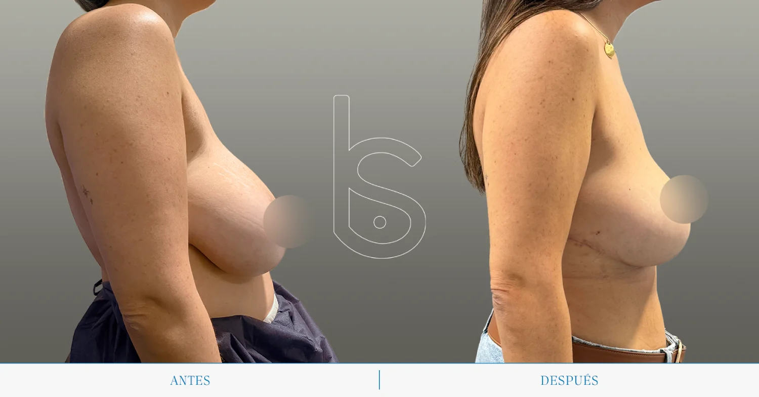 Caso de reducción perfil