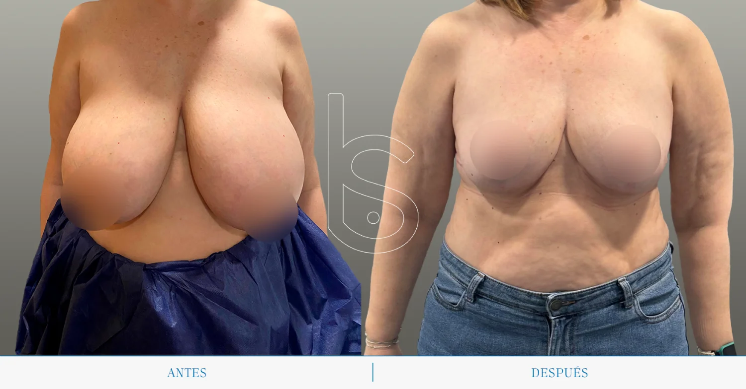 Caso de reducción frente