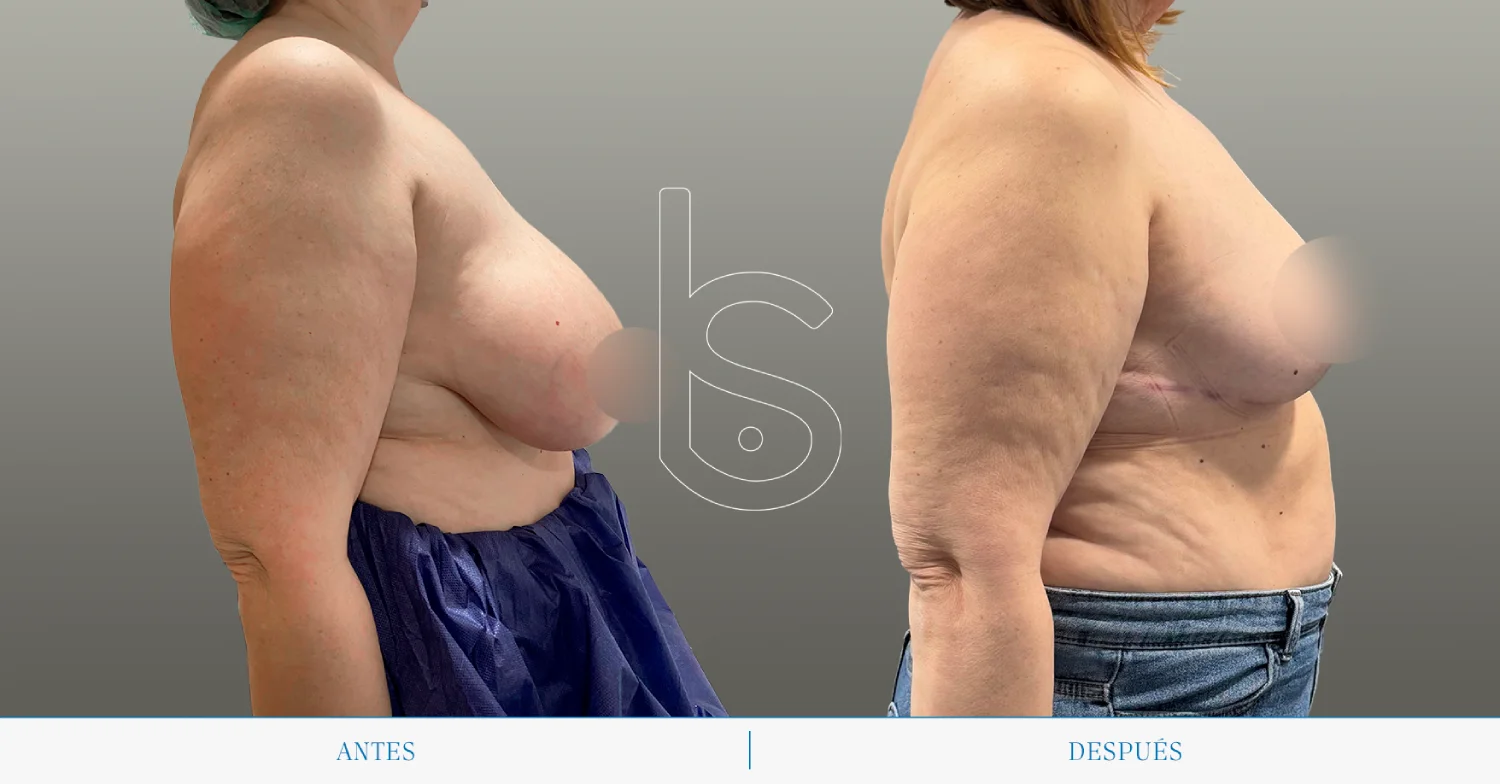 Caso de reducción perfil