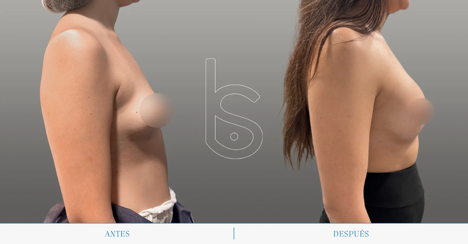 Caso de mamas tuberosas perfil