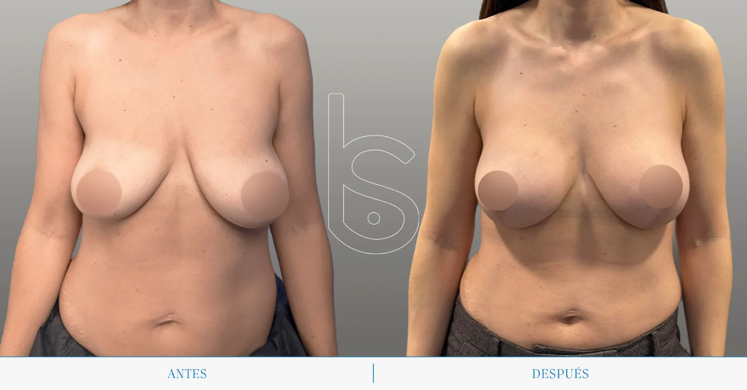 Caso de mastopexia frente