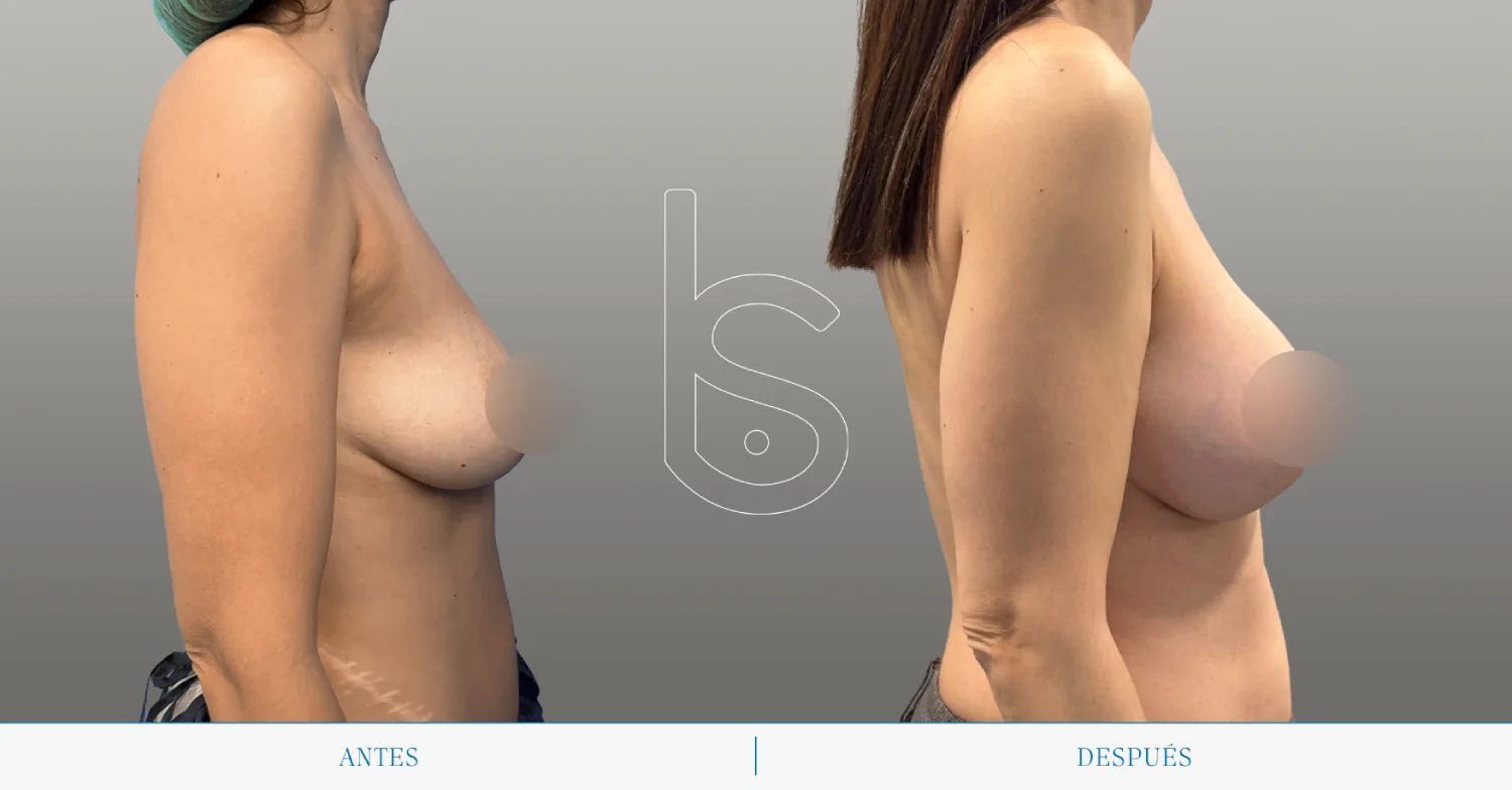 Caso de mastopexia perfil