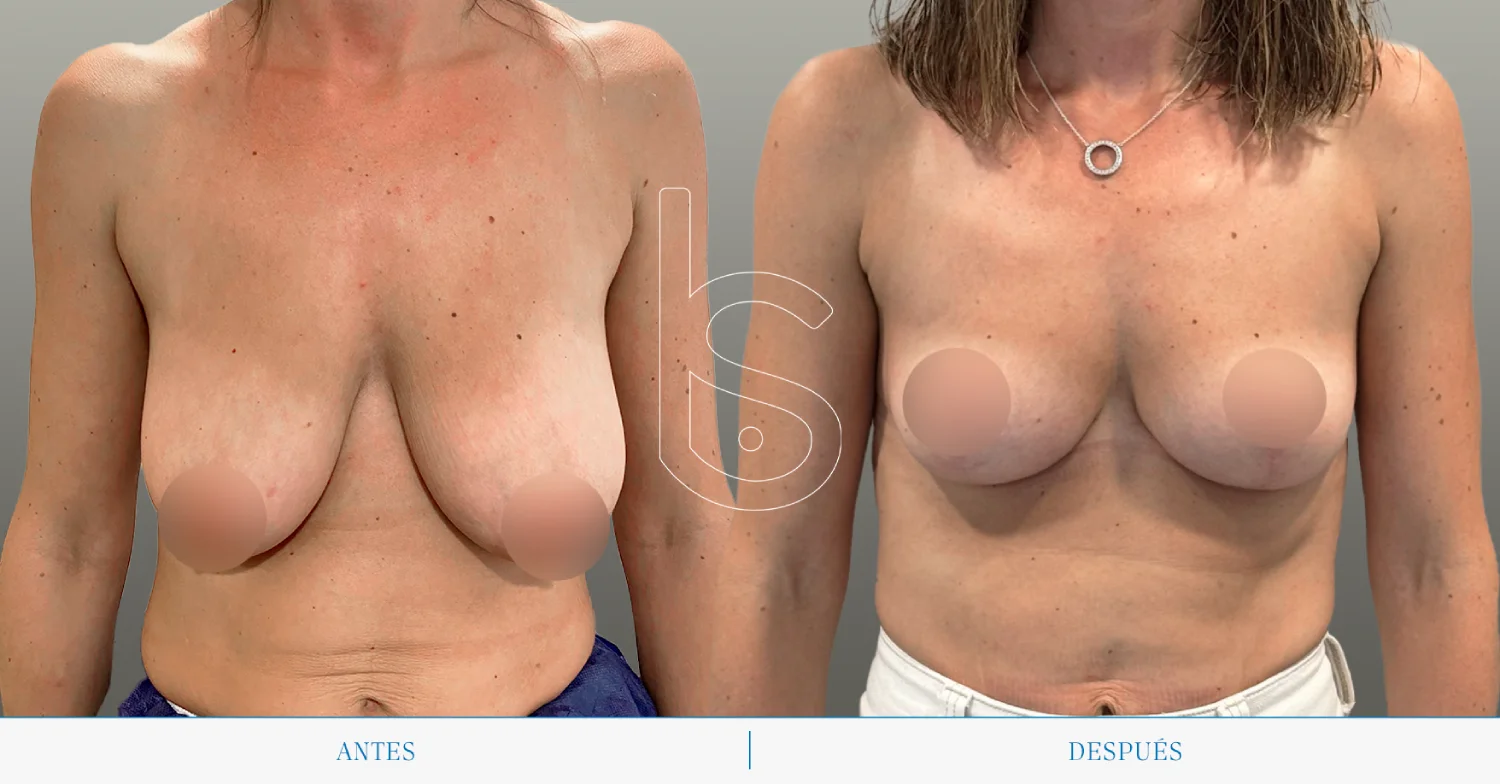 Caso de mastopexia frente