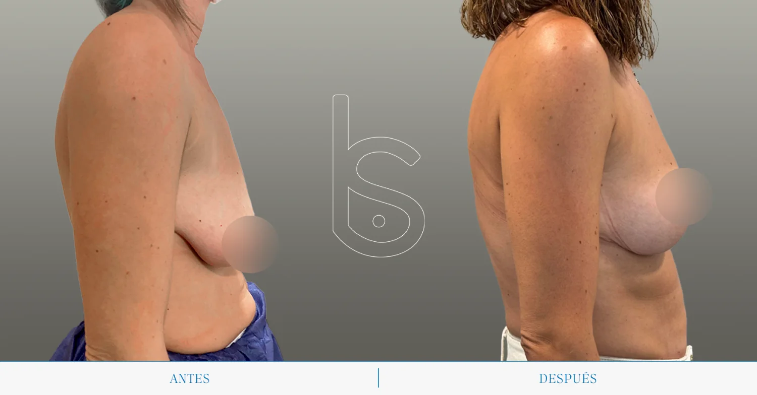 Caso de mastopexia perfil