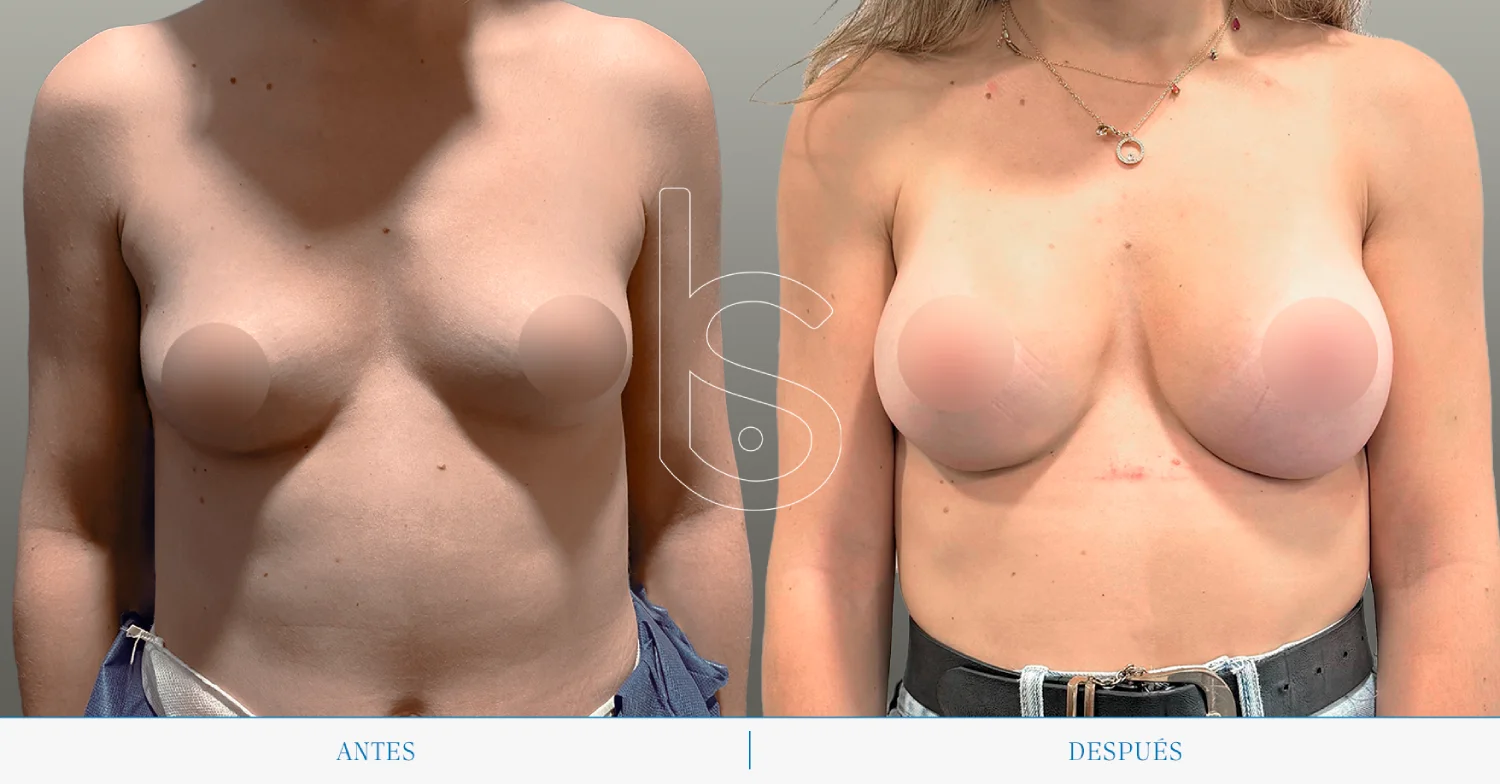 Caso de aumento frente