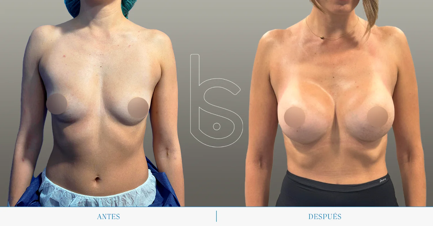 Caso de aumento frente