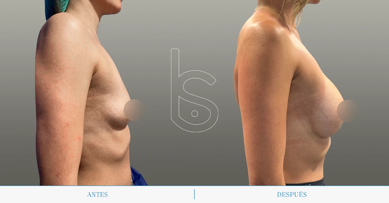 Caso de aumento perfil