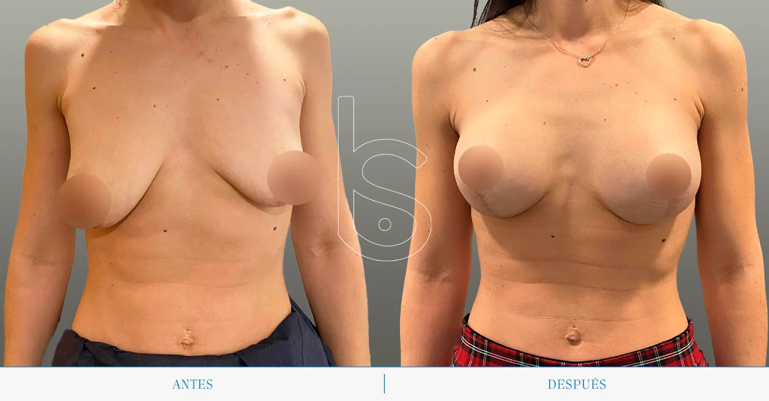 Caso de mastopexia frente