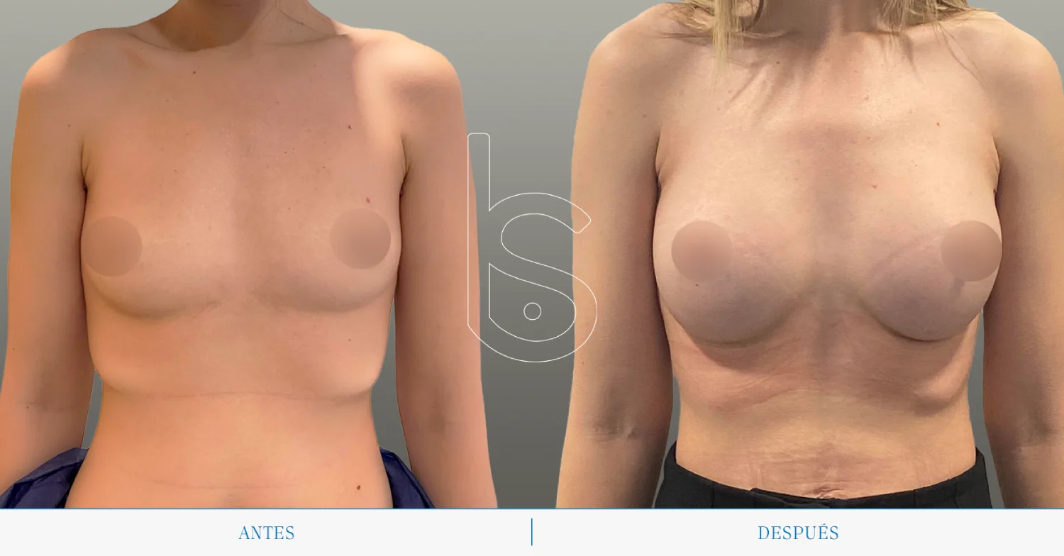 Caso de aumento frente