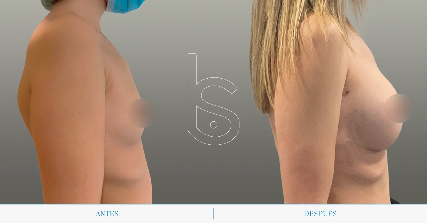 Caso de aumento perfil