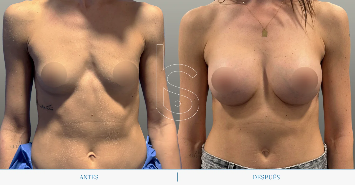 Caso de aumento frente