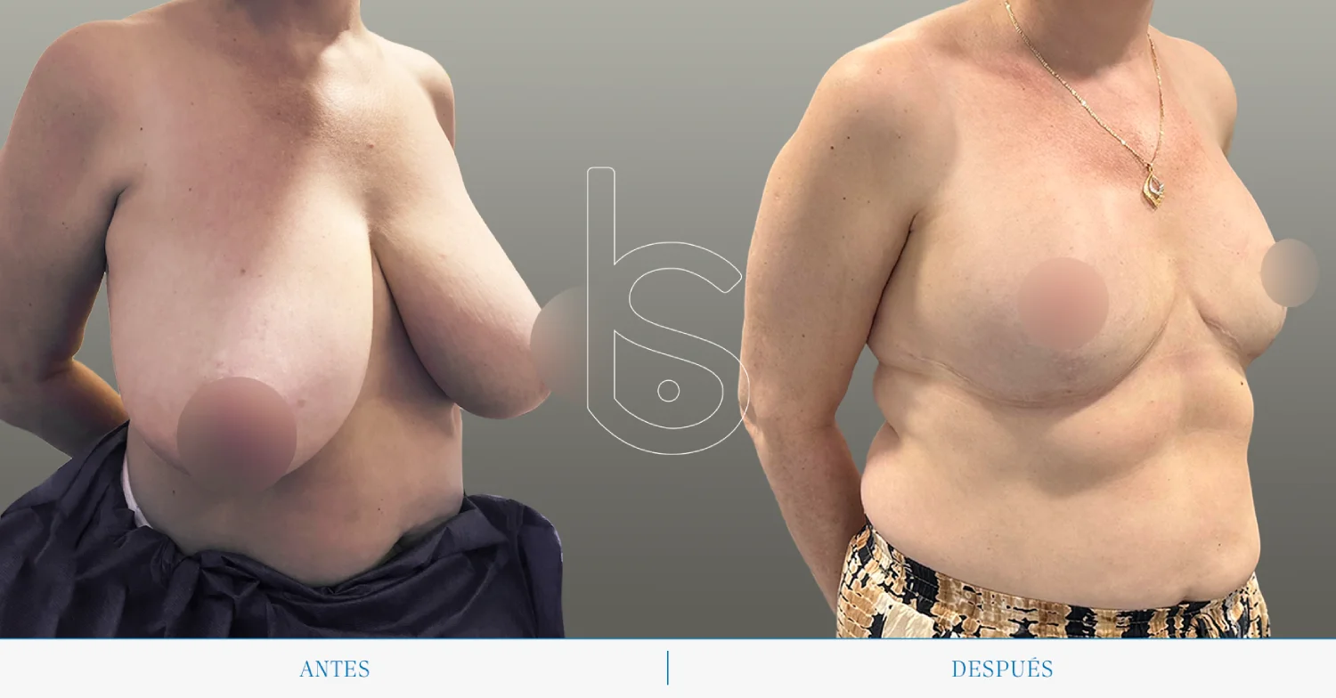 Caso de reducción lateral