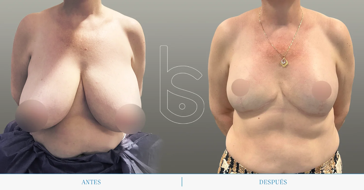 Caso de reducción frente