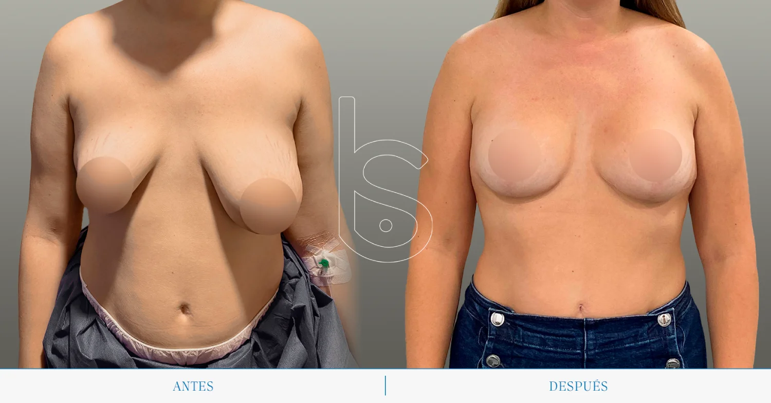 Caso de mastopexia frente