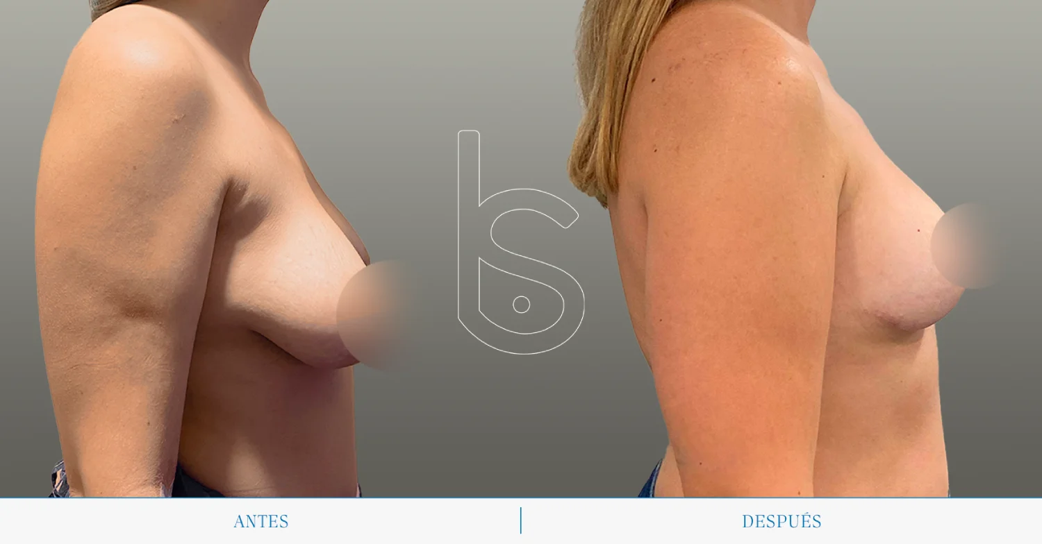 Caso de mastopexia perfil
