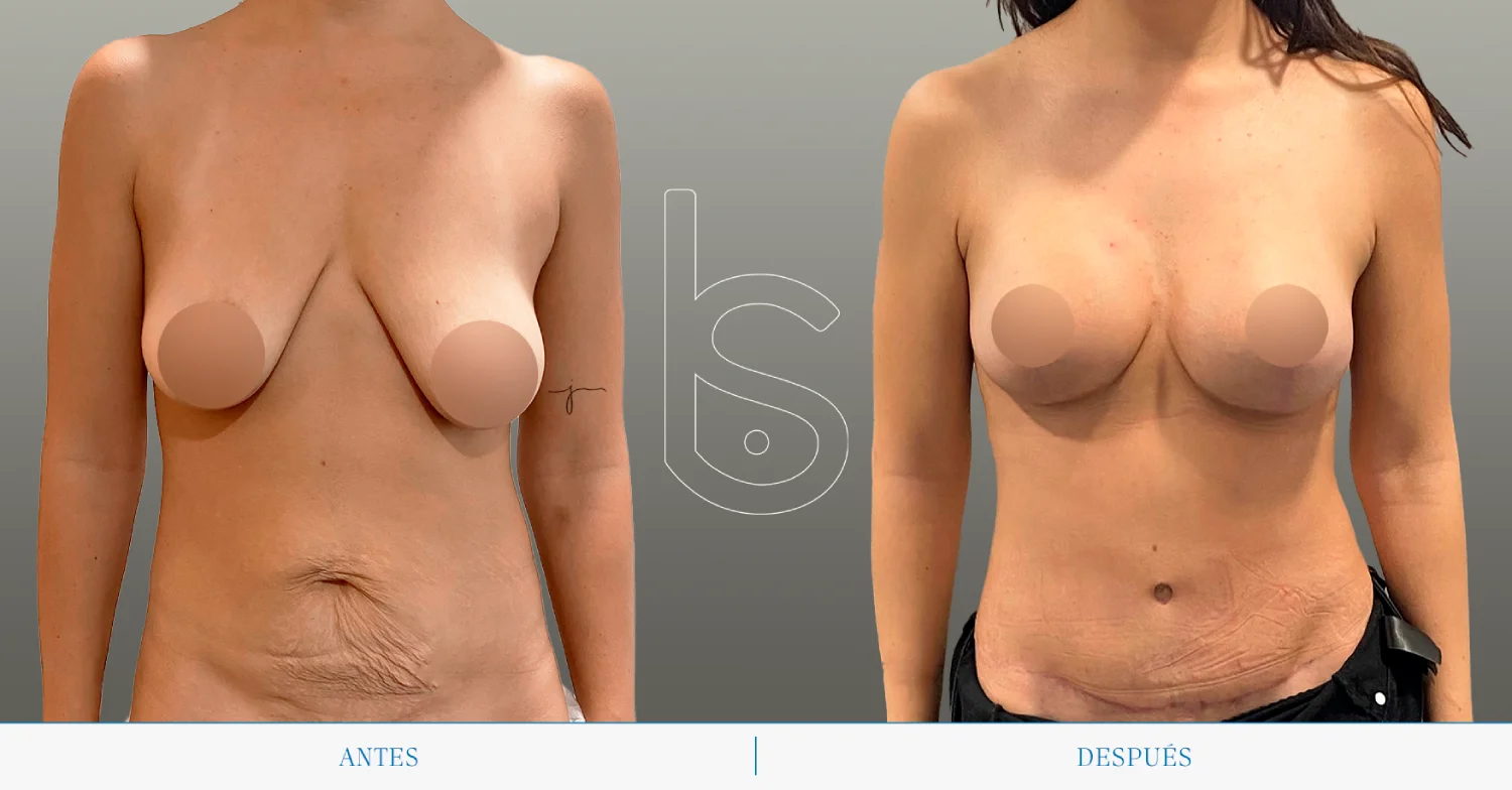 Caso de mastopexia frente