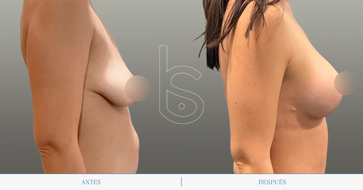 Caso de mastopexia perfil