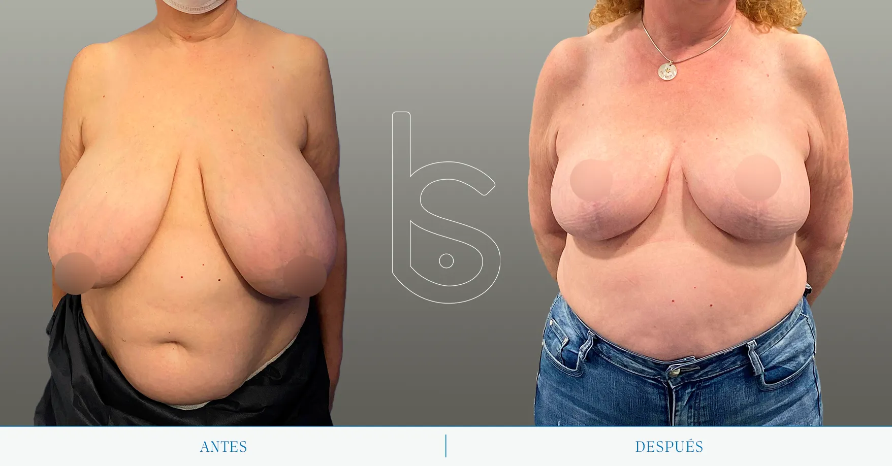 Caso reducción de pecho frente