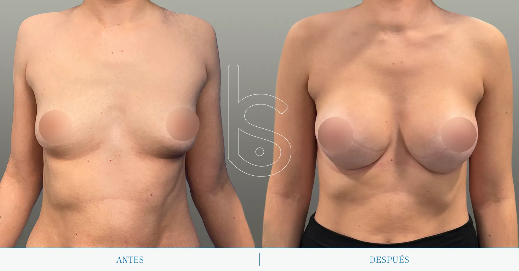 Caso de mamas tuberosas frente