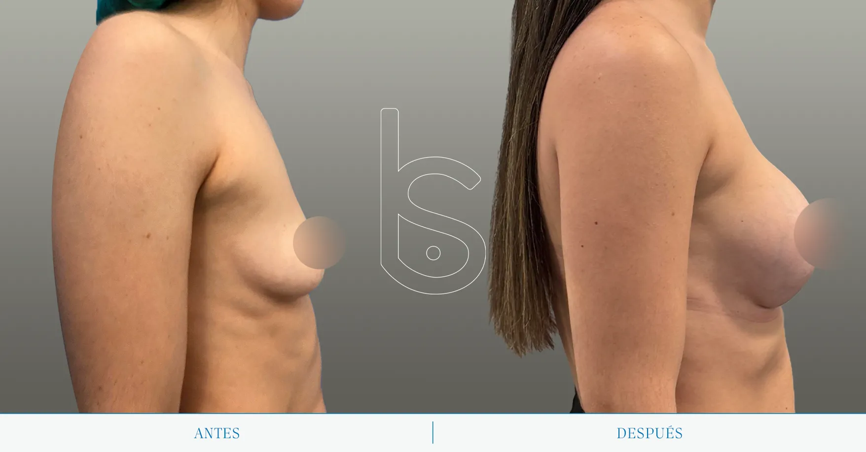 Caso de mamas tuberosas perfil