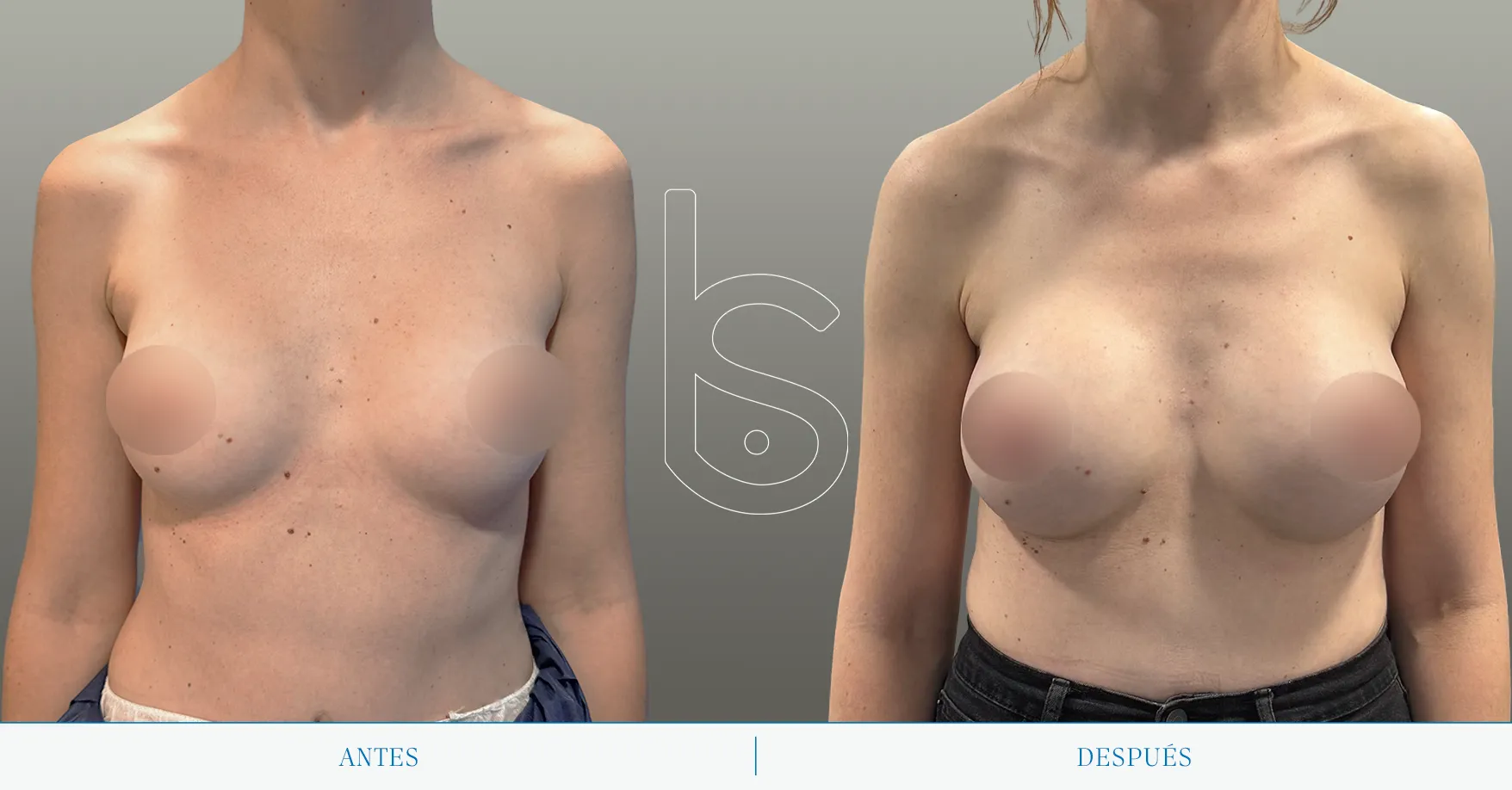 Caso de aumento frente