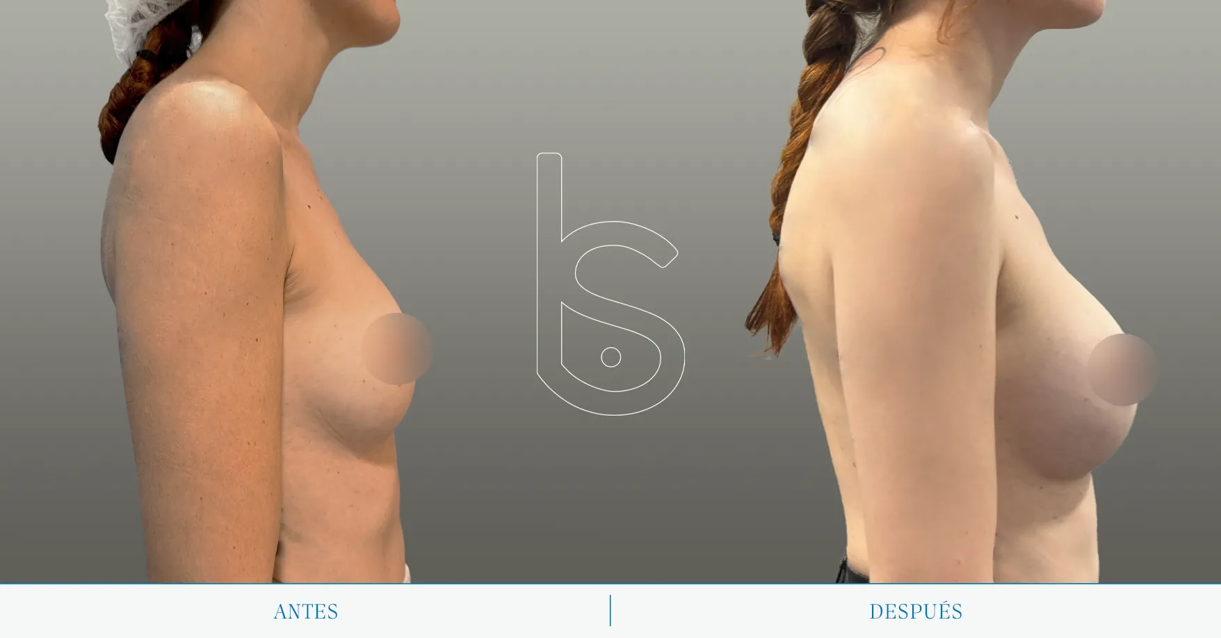 Caso de aumento perfil