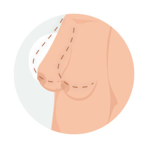 Ilustración de pecho femenino caído