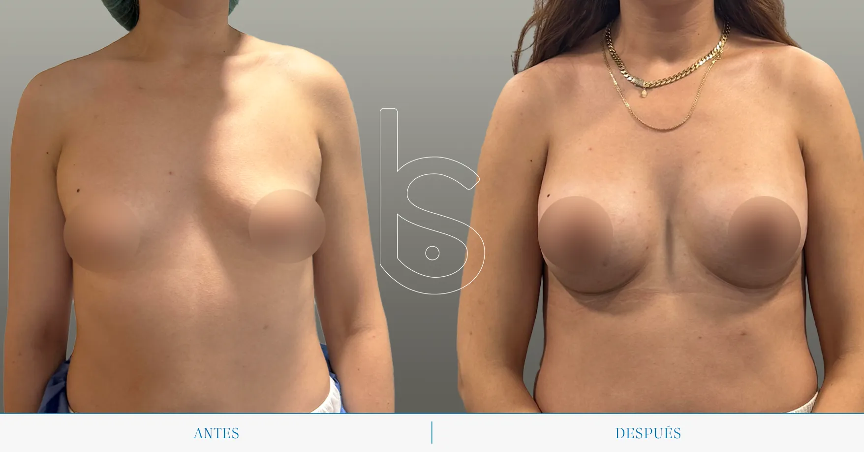 Caso de mamas tuberosas frente